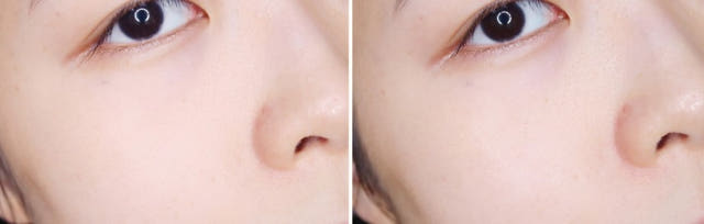 Pure Hills Sentela Ampel Essence Recommended Acne 