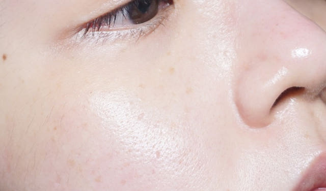 Pure Hills Sentela Ampel Essence Recommended Acne 