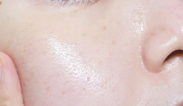 Pure Hills Sentela Ampel Essence Recommended Acne 