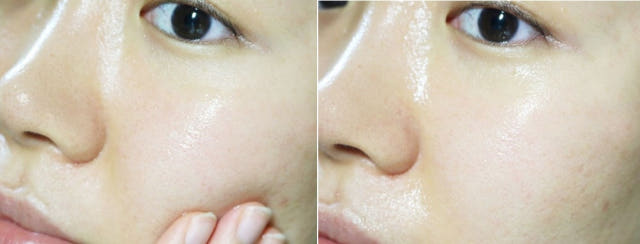 Pure Hills Sentela Ampel Essence Recommended Acne 