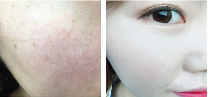 Dullness + pigmentation + under dark dark + darkne