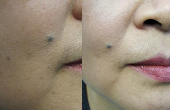 Dullness + pigmentation + under dark dark + darkne