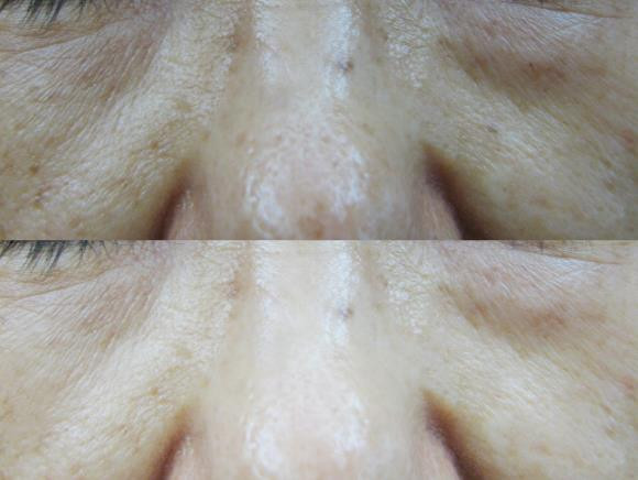 Dullness + pigmentation + under dark dark + darkne