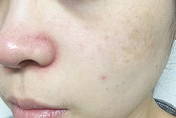 Dullness + pigmentation + under dark dark + darkne