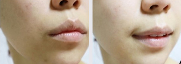 New Cellarilator Ointment Cream 30ml Skin Trail Im