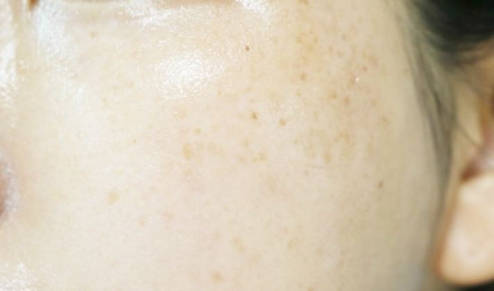 Dullness + pigmentation + under dark dark + darkne