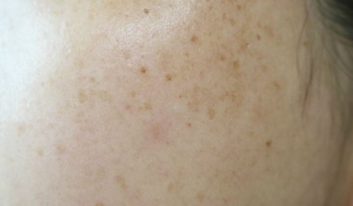 Dullness + pigmentation + under dark dark + darkne