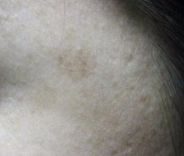 Dullness + pigmentation + under dark dark + darkne