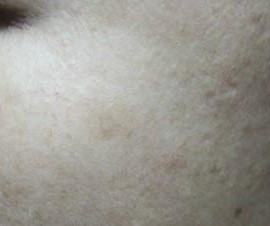 Dullness + pigmentation + under dark dark + darkne