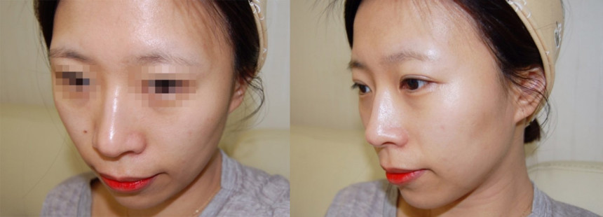 Greymelin Hyaluronic Acid 100 Serum 50ml Lonicic A