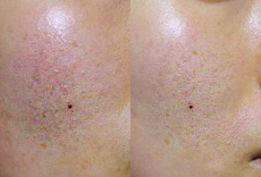 How to Reduce Acne Scars Pores How to Reduce Acne 