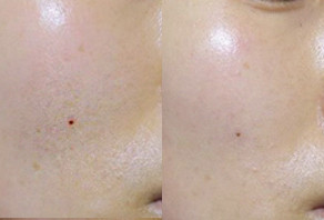 How to Reduce Acne Scars Pores How to Reduce Acne 