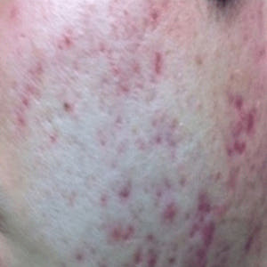 안나홀츠 얼굴 색소침착 바르는 비타민C 17  세럼 에센스 앰플 60ml... 솔직 후기 | 피부 타입별 분석 - 상품 이미지 2