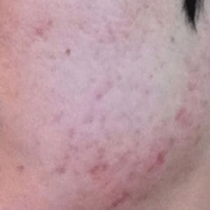 안나홀츠 얼굴 색소침착 바르는 비타민C 17  세럼 에센스 앰플 60ml... 솔직 후기 | 피부 타입별 분석 - 상품 이미지 3