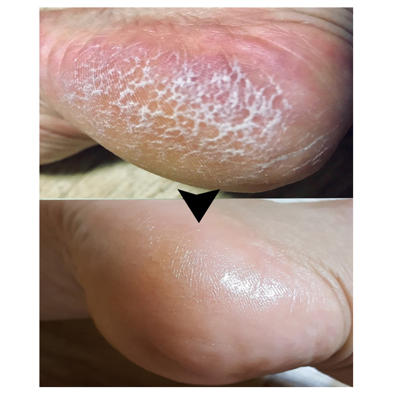 발뒤꿈치각질제거제 발각질연화제 풋밤 시어버터 풋스틱 - 상세 이미지 4