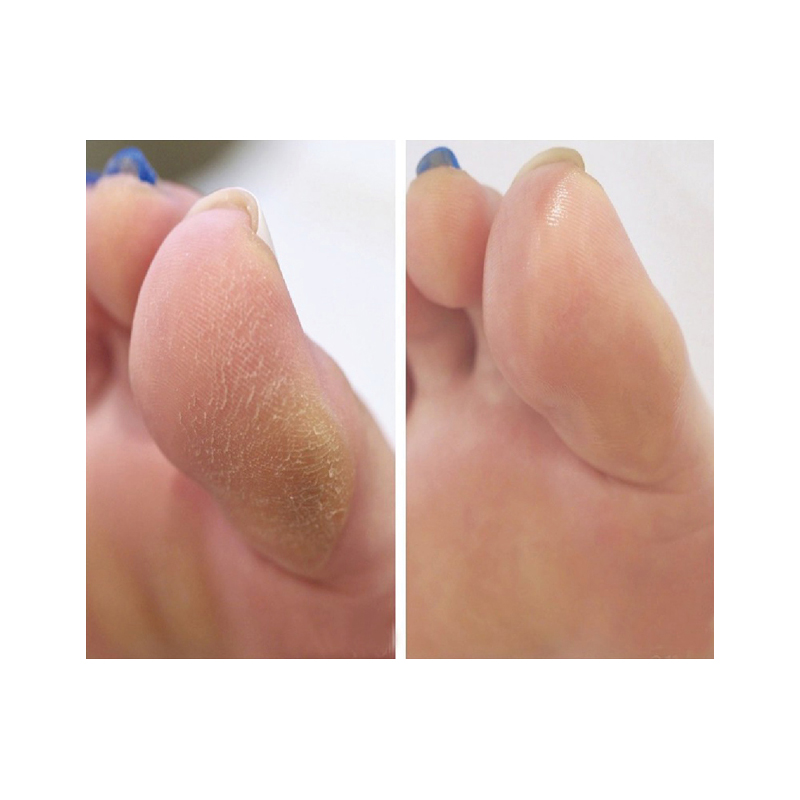 발뒤꿈치각질제거제 발각질연화제 풋밤 시어버터 풋스틱 - 상세 이미지 2