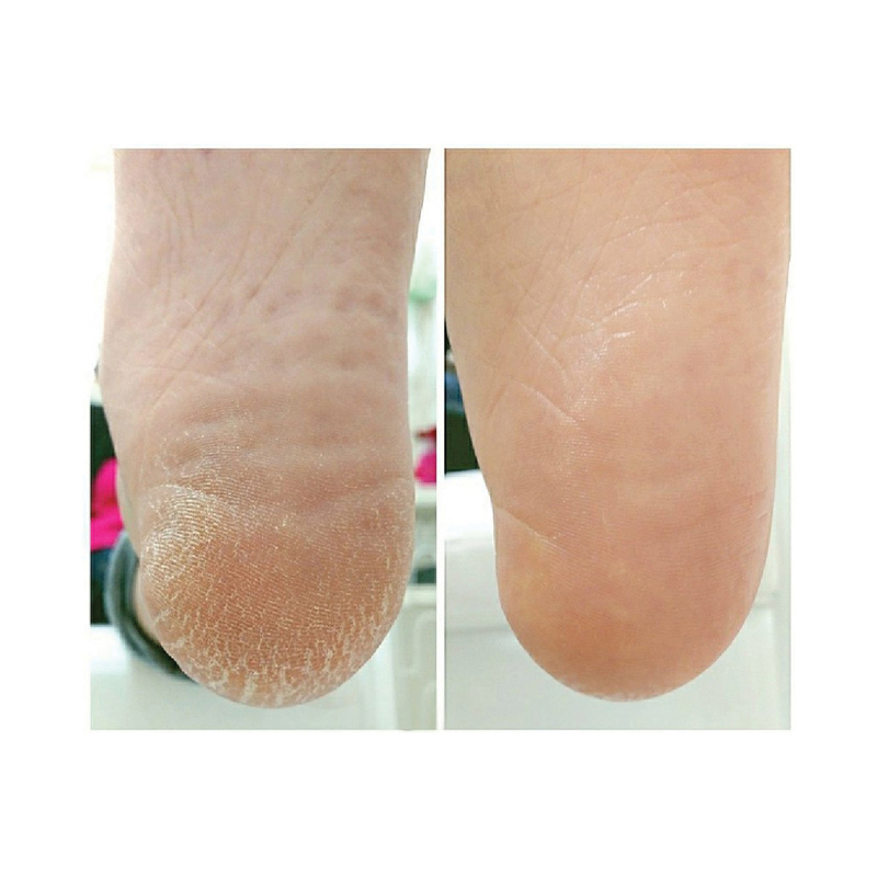 발뒤꿈치각질제거제 발각질연화제 풋밤 시어버터 풋스틱 - 상세 이미지 3