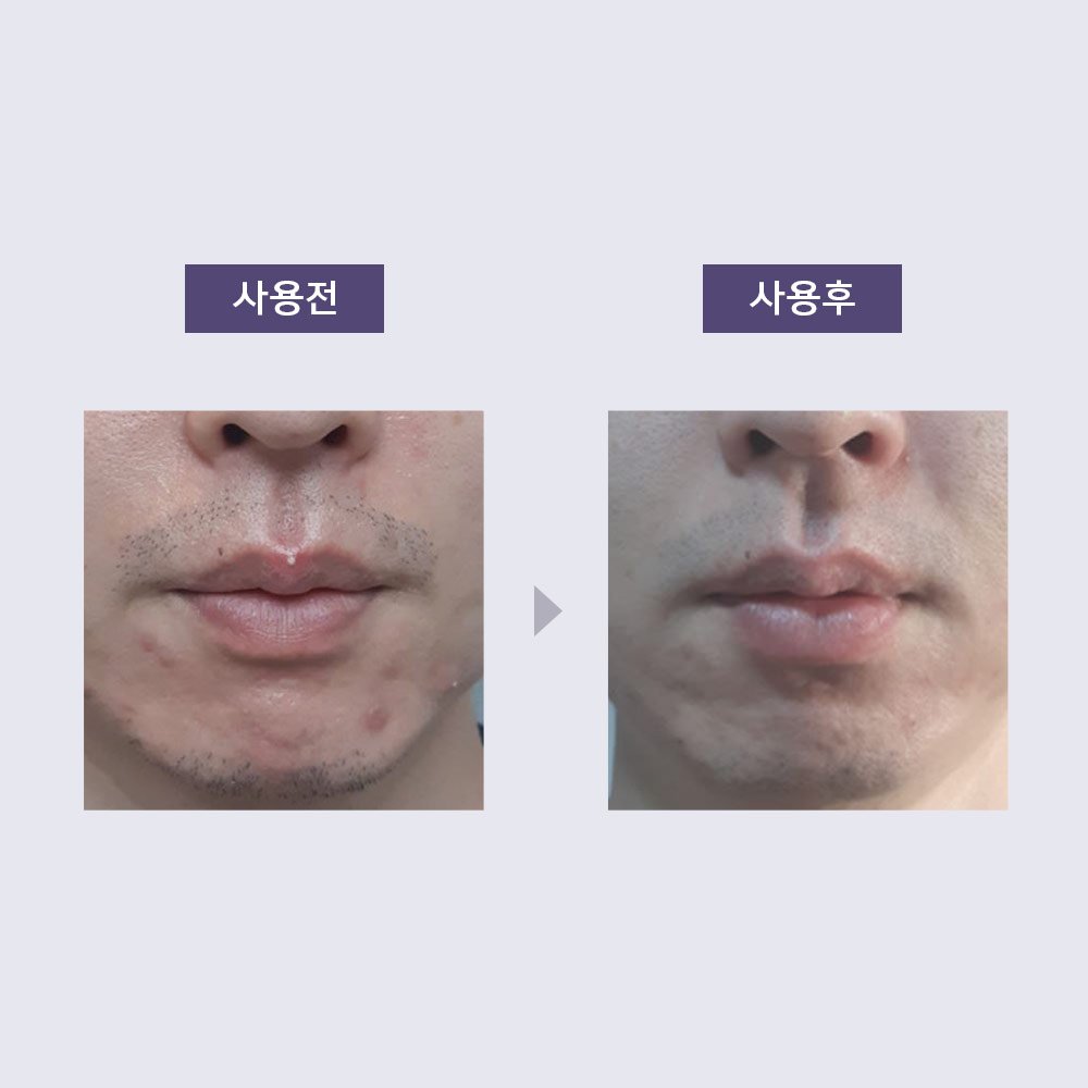 아클레온 센텔라드레싱파우더 티트리 염증 여드름 스팟 젤 30ml 여드름 빨간 붉은 자국 - 상세 이미지 3