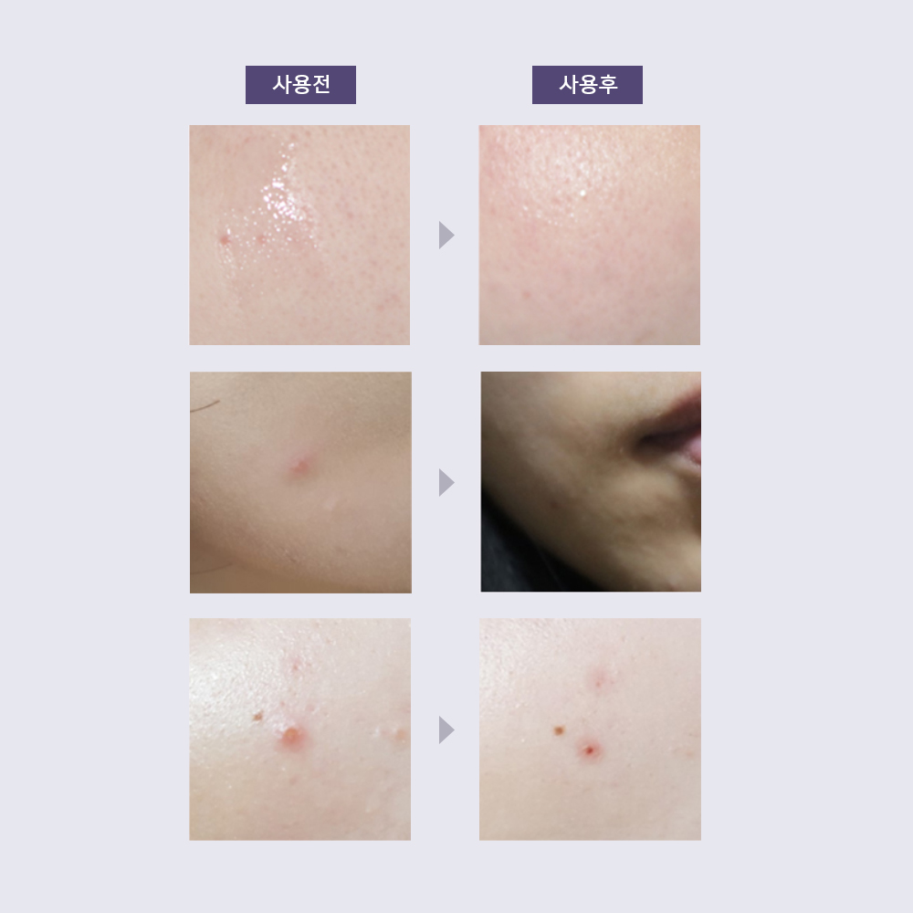 아클레온 센텔라파우더 티트리 염증성 여드름 스팟 젤 30ml 2개 얼굴좁쌀두드러기 - 상세 이미지 4