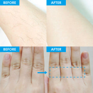 텐미닛 제모크림 겨드랑이 여자 인중제모 똥꼬털 겨털 남자 다리털 종아리 ... 솔직 후기 | 피부 타입별 분석 - 상품 이미지 3