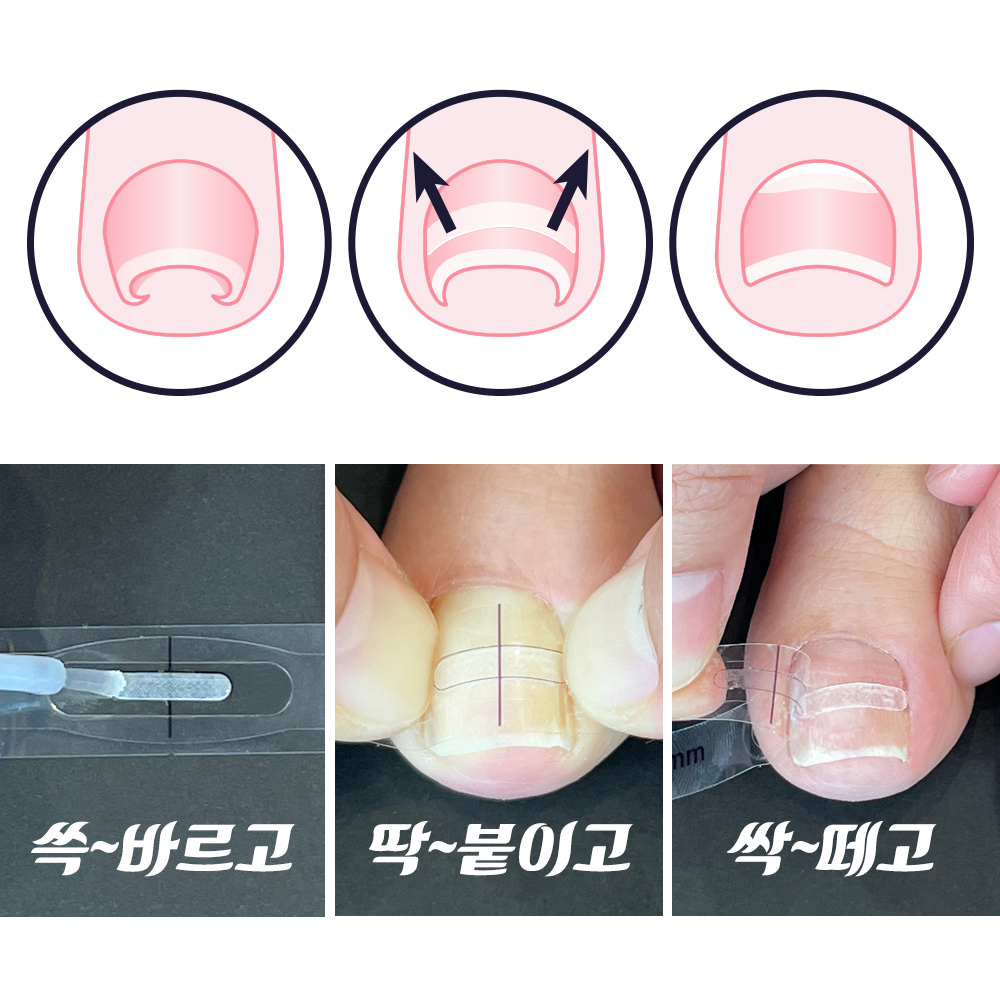 퍼펙토 내성 발톱 교정 스트립 퍼펙토 내성 발톱 교정 스트립