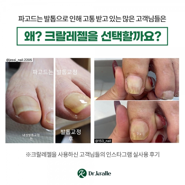 닥터크랄레 크랄레젤 미니 3종세트   파고드는 발톱 평평하게!! - 상세 이미지 4