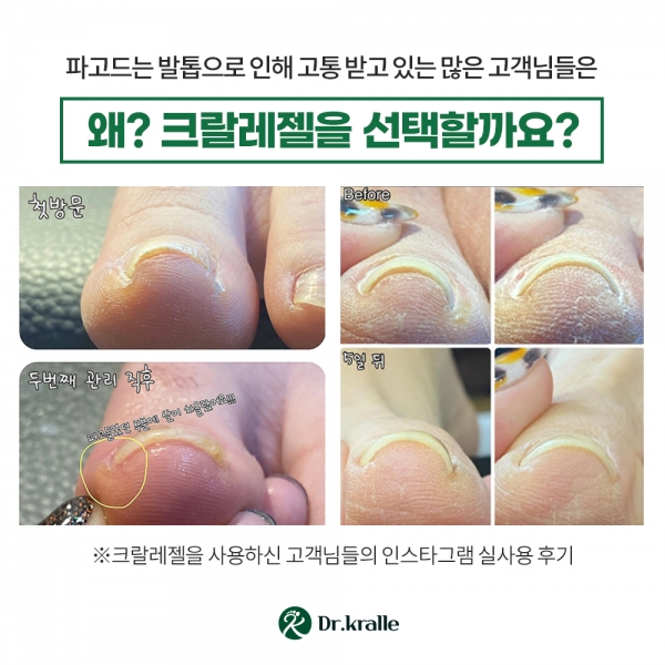 닥터크랄레 크랄레젤 미니 3종세트   파고드는 발톱 평평하게!! - 상세 이미지 5