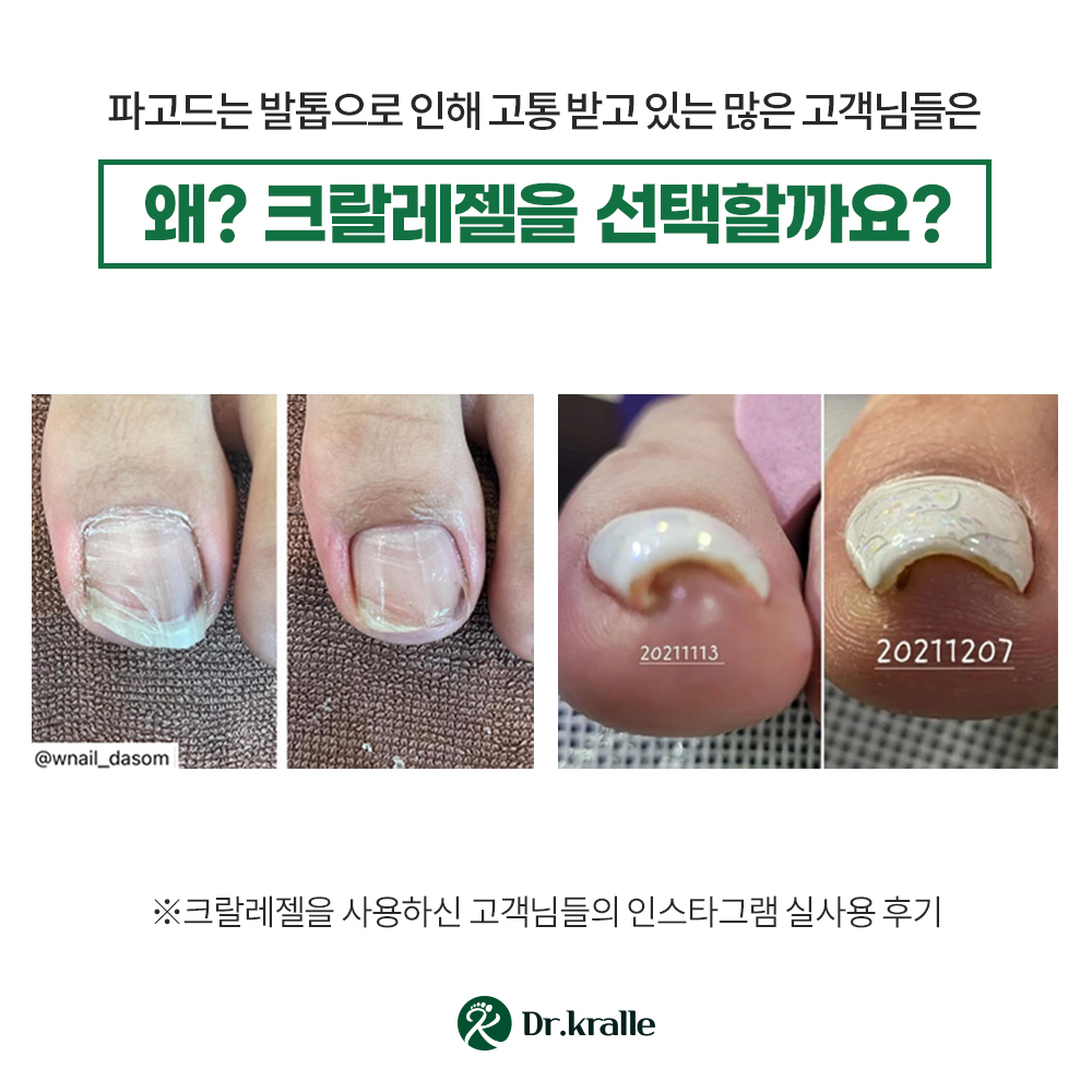 닥터크랄레 크랄레젤 미니 3종세트 파고드는 발톱 평평하게!! 이미지 6