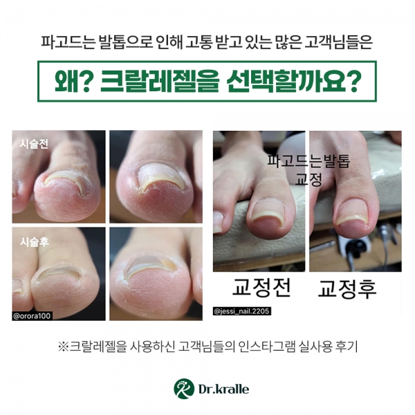 닥터크랄레 크랄레젤 미니 3종세트   파고드는 발톱 평평하게!! - 상세 이미지 3