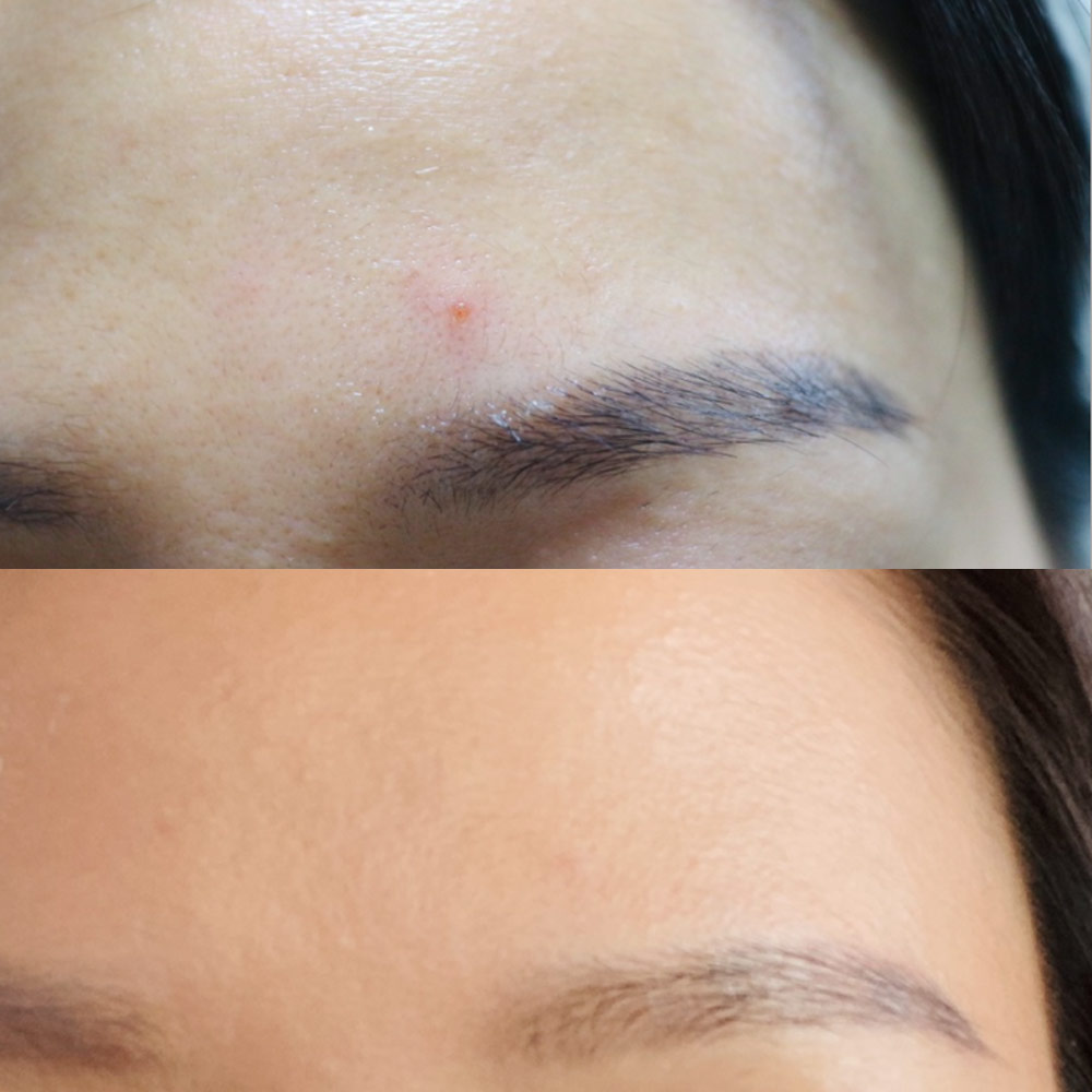 아클레온 센텔라파우더 티트리 염증성 여드름 스팟 젤 30ml 2개 얼굴좁쌀두드러기 - 상세 이미지 5