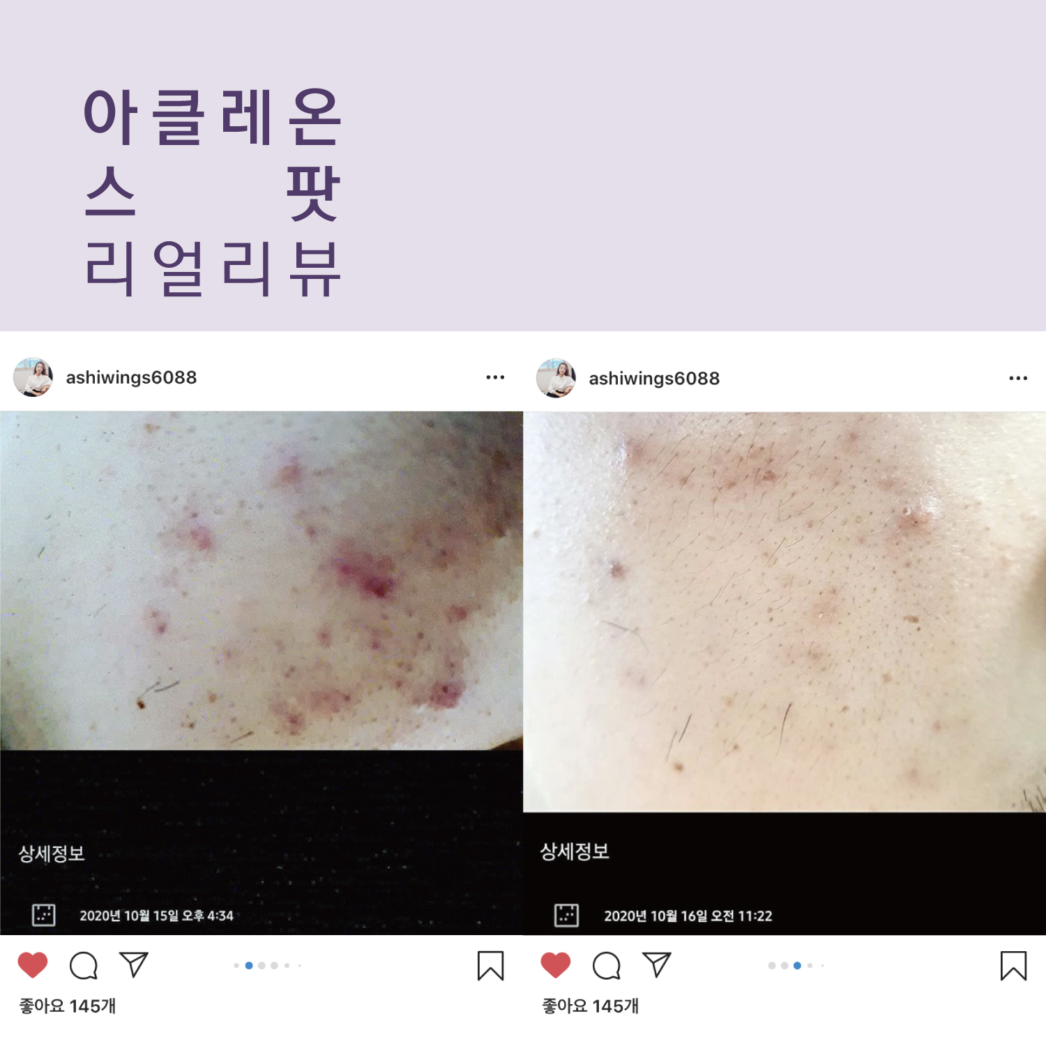 아클레온 센텔라파우더 티트리 염증성 여드름 스팟 젤 30ml 2개 얼굴좁쌀두드러기 - 상세 이미지 4