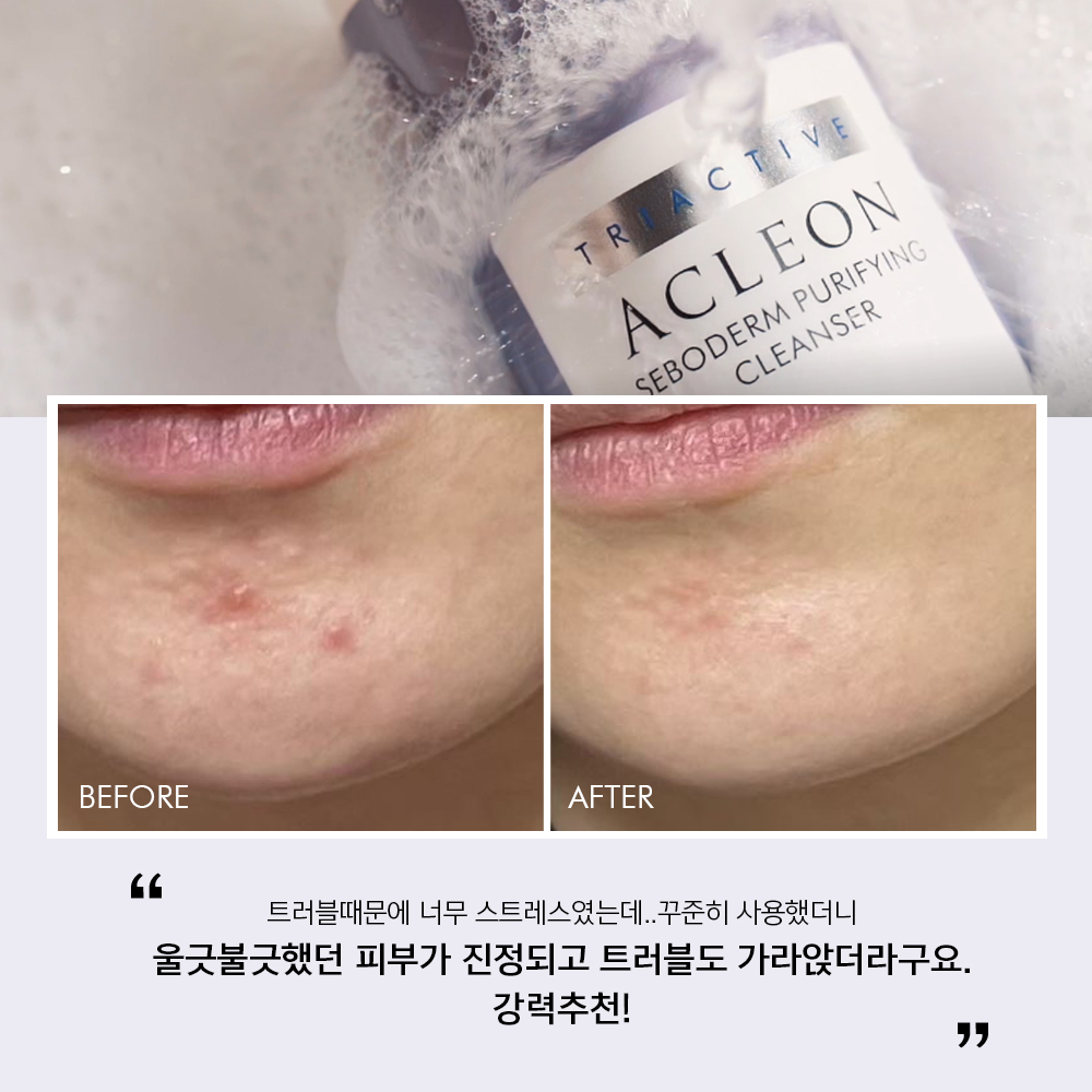 아클레온 좁쌀여드름 약알칼리성 판테놀 클렌징폼 청소년 여드름 세안제 요철클렌징 200ml - 상세 이미지 5