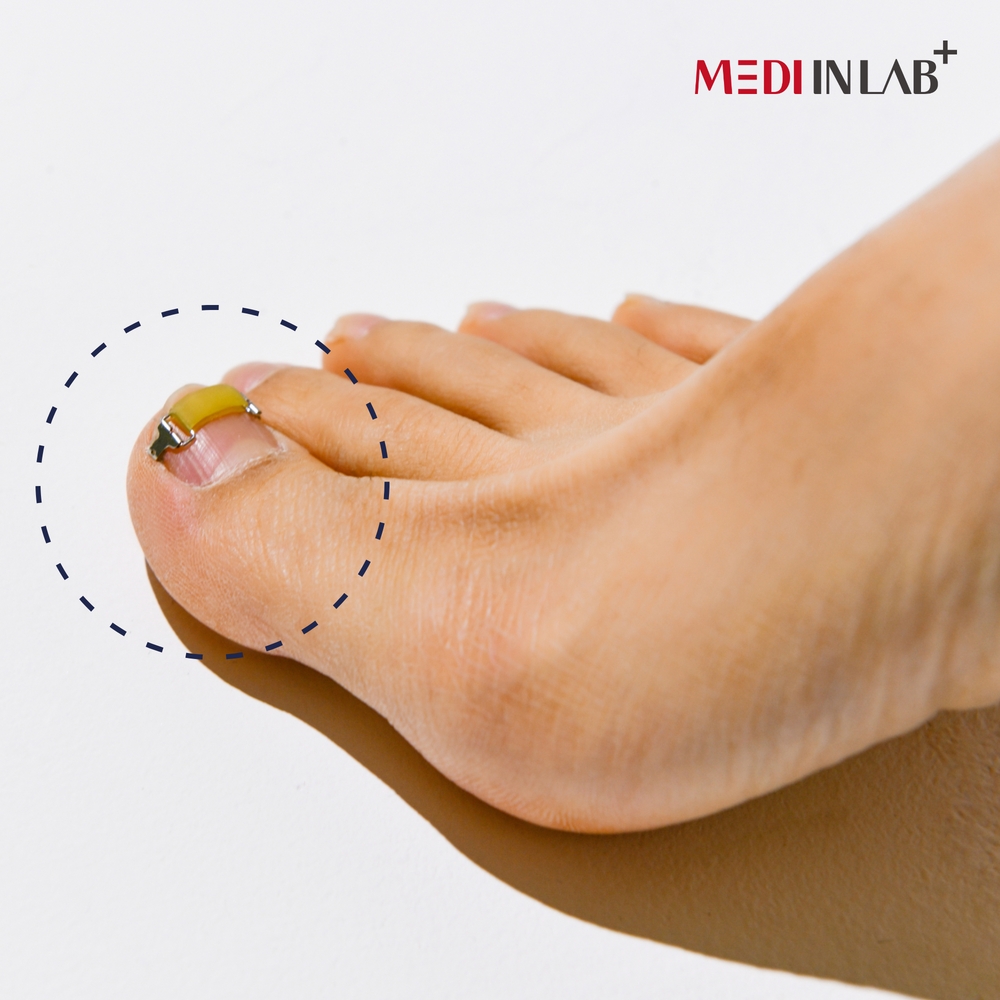 메디인랩 내성발톱 교정기 교정 파고드는 내향성 발톱 테이프