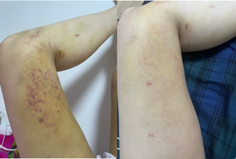 케이옥시덤 피부과 인모드 비타민K 멍크림 15ml 피멍연고 주사비 피부멍 자반증 홍조 이미지 8