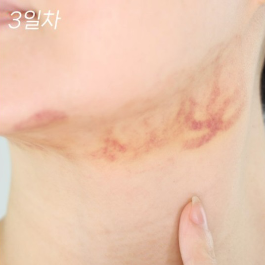 디에스 애프터 올인원K 성형붓기수분진정 혈행개선 아르니카 비타민k 인모드 20ml, 1개 - 상세 이미지 4
