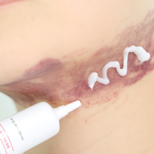 디에스 애프터 올인원K 성형붓기수분진정 혈행개선 아르니카 비타민k 인모드 20ml, 1개 - 상세 이미지 3