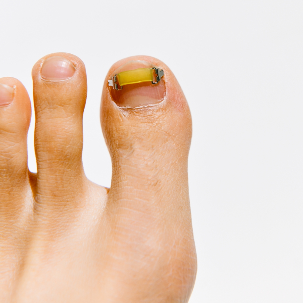 메디인랩 내성발톱 교정기 교정 파고드는 내향성 발톱 테이프