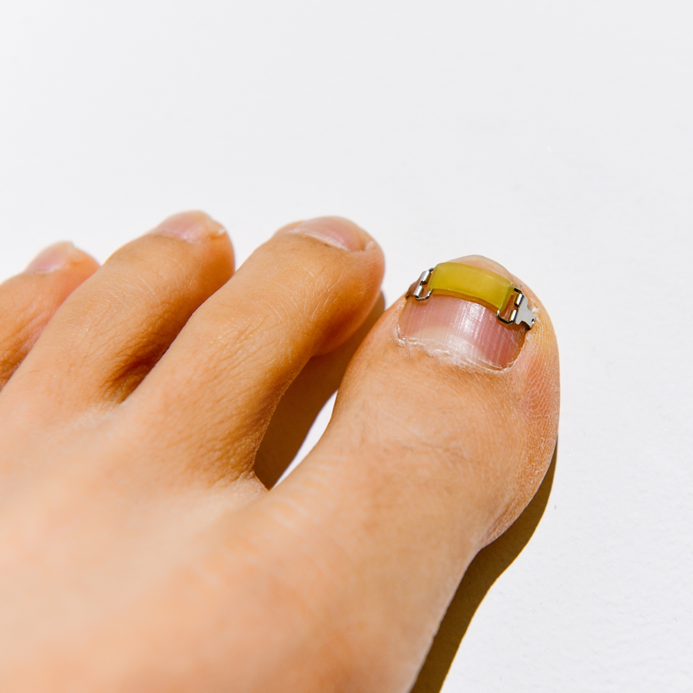 메디인랩 내성발톱 교정기 교정 파고드는 내향성 발톱 테이프