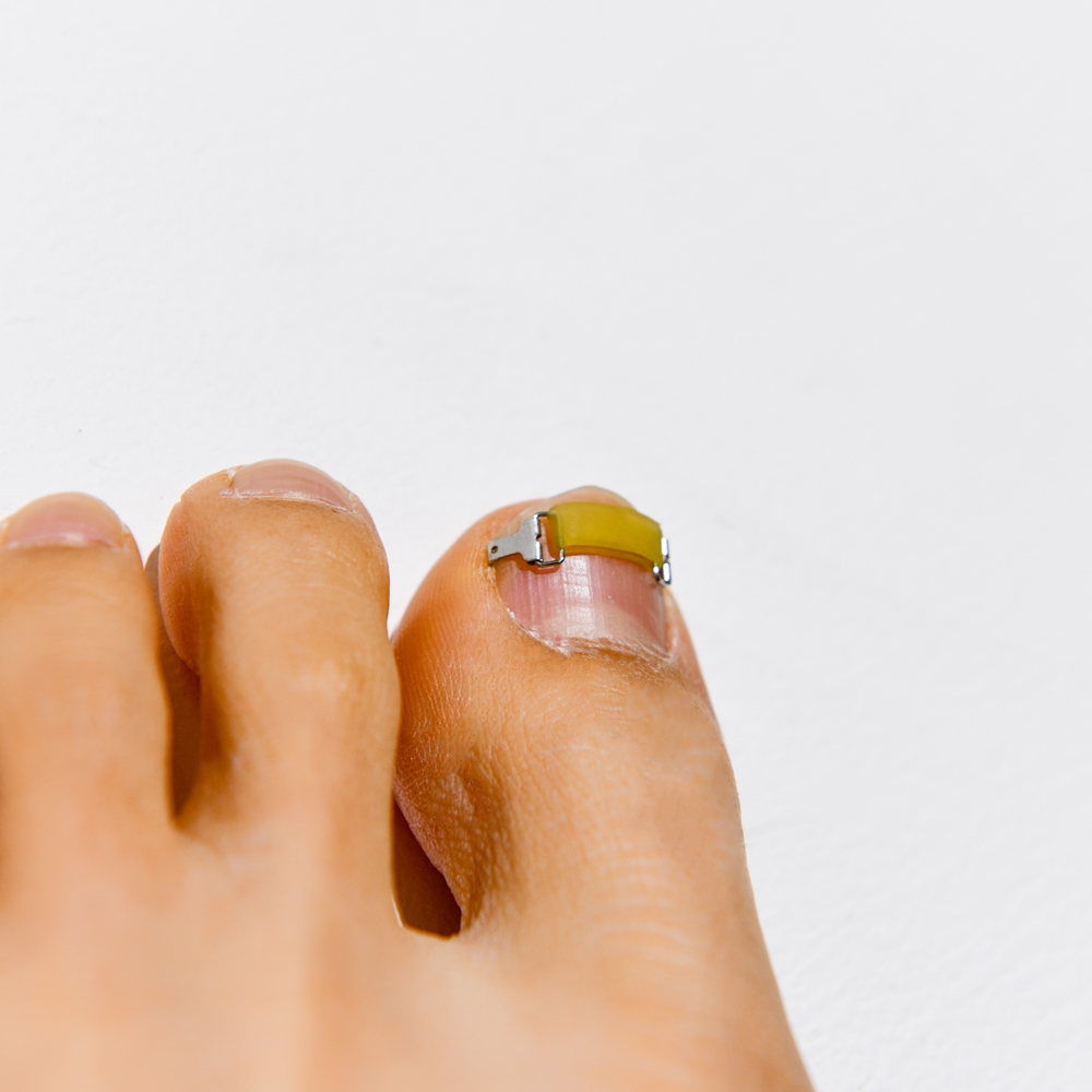 메디인랩 내성발톱 교정기 교정 파고드는 내향성 발톱 테이프