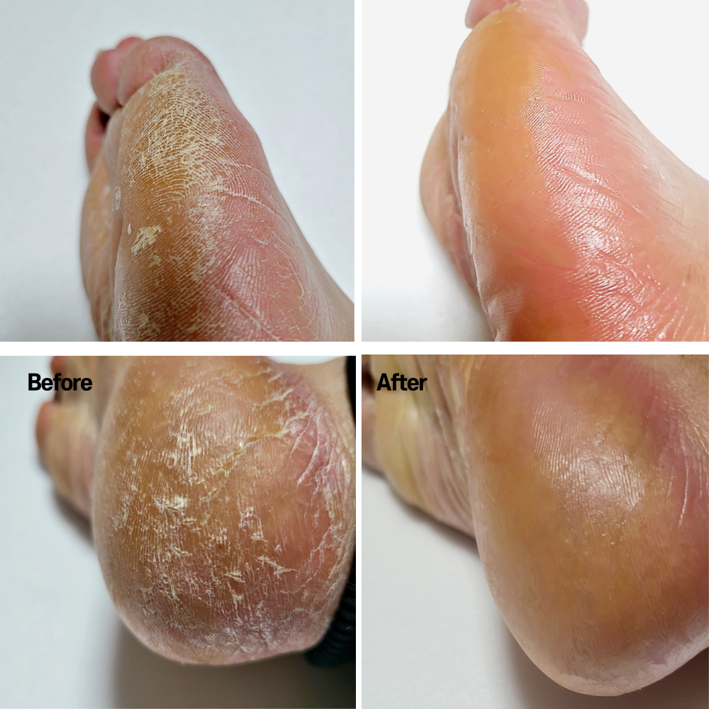 발 각질제거기 뒷꿈치 발뒤꿈치 발바닥 각질 제거 관리 글라스 골드 - 상세 이미지 2