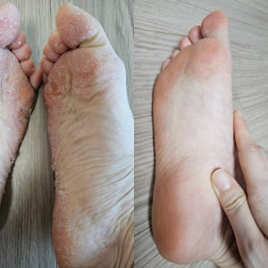 발팩장인 페로린 뒤꿈치갈라짐 각질제거 필링팩 발바닥 굳은살 연화제 풋마스... 솔직 후기 | 피부 타입별 분석 - 상품 이미지 4