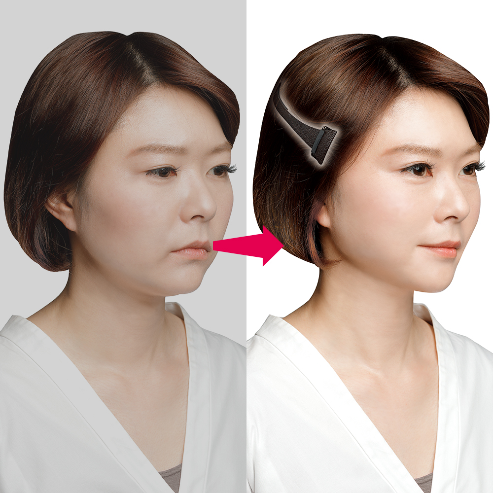 와사비네코 순간리프트업 리프팅클립 페이스 얼굴리프팅 팔자주름 즉석 땡기미 땡김이 얼굴 밴드 - 상품 이미지