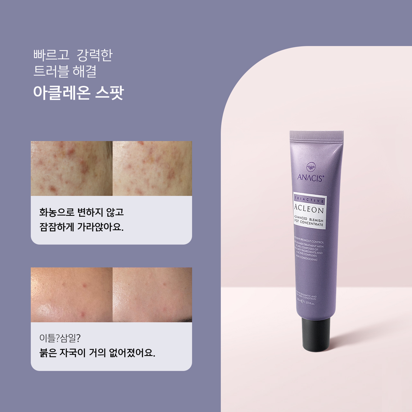 얼굴 요철 피부 트러블 아클레온 여드름 연고 사용법