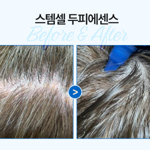 안달로우 아르간 스템셀 가려움 해결 민감성 두피 에센스 세럼 62ml, ... 솔직 후기 | 피부 타입별 분석 - 상품 이미지 2