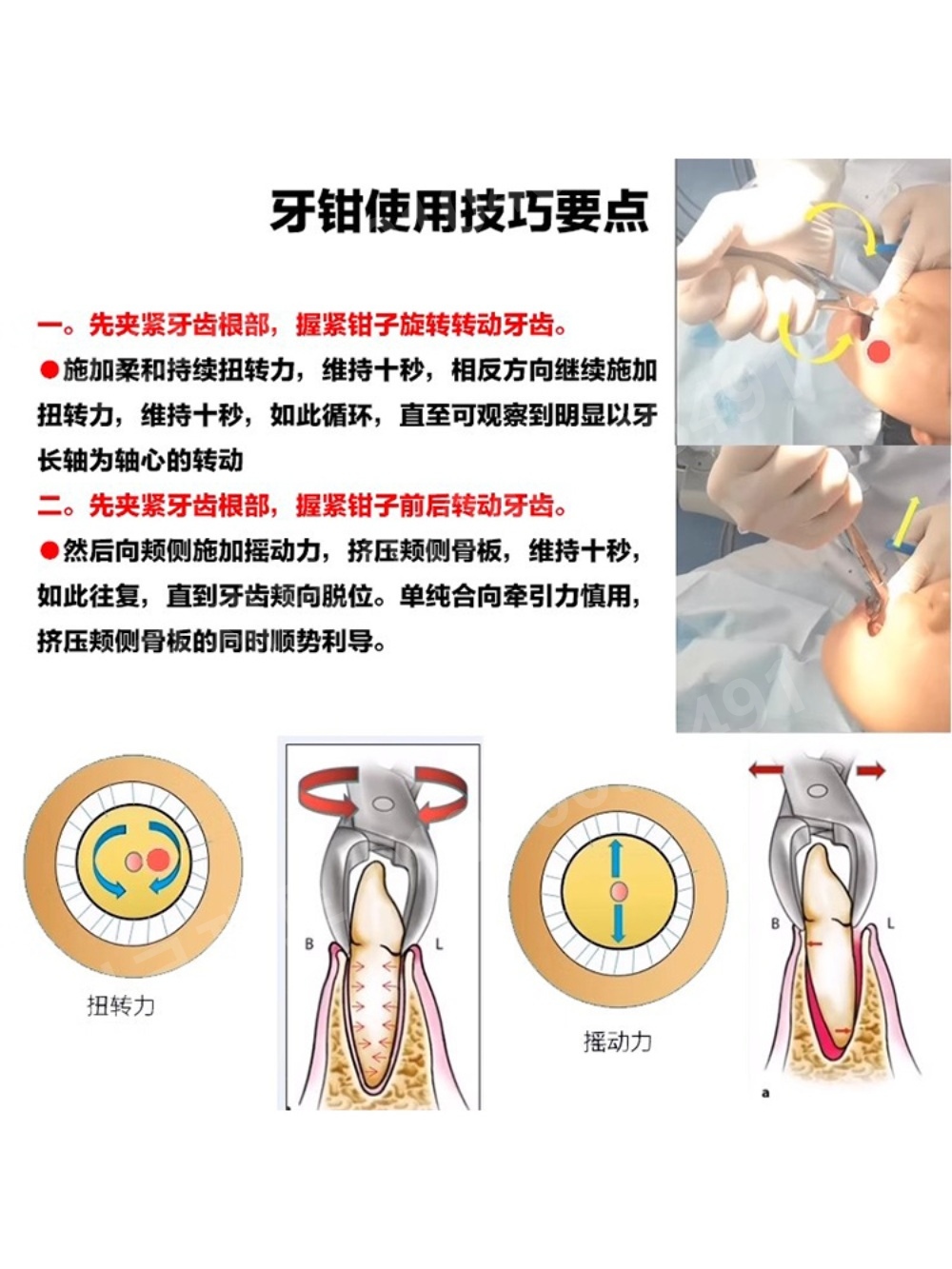 치과 집게 발치 포셉 도구 스테인레스 소아용 플라이어 - 상세 이미지 3