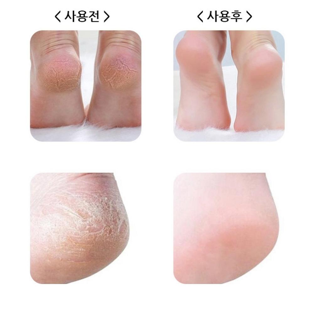 티눈제거칼 발바닥 굳은살제거칼 손가락굳은살제거