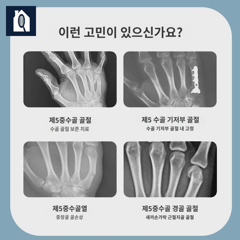 손가락지지대 버팀대 고정 약지 새끼손가락 보호대 인대 골절 - 상세 이미지 2