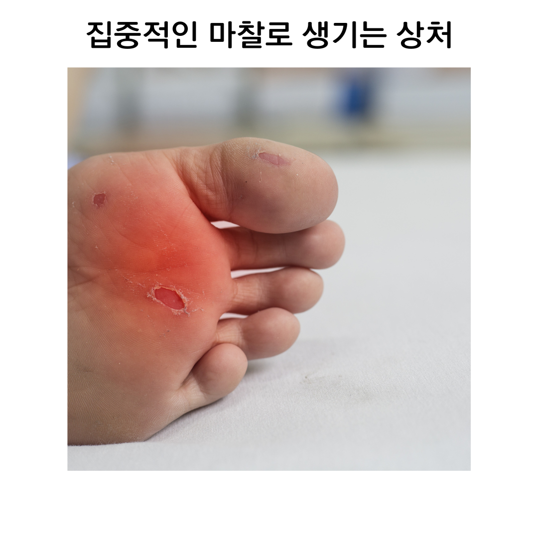 독일 에파지트 물집방지겔 발바닥 물집 발 뒤꿈치 패드 밴드 크림 17ml - 상세 이미지 4