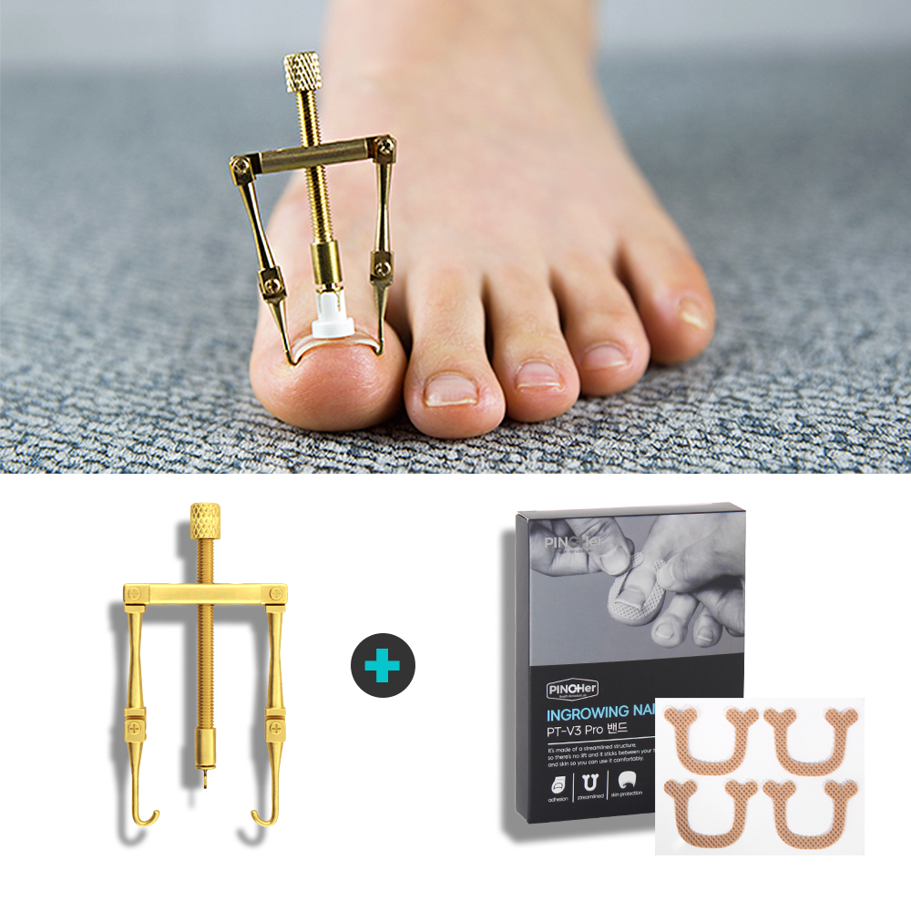 핀처 테이프 내성발톱 교정기 파고드는 발톱 교정