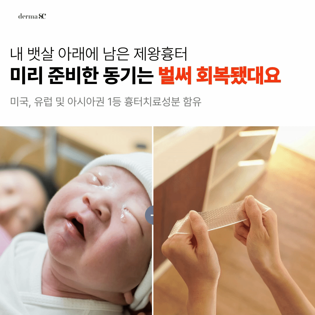 제왕절개 흉터 흉터 관리 실리콘 겔 시트 더마에스씨 후기 제왕절개 흉터 관리